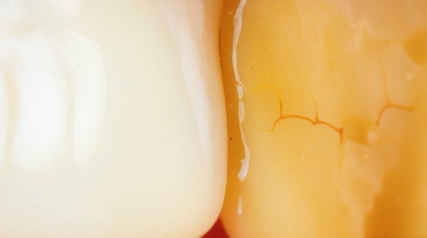 10 signes précoces d'une carie dentaire à ne pas ignorer